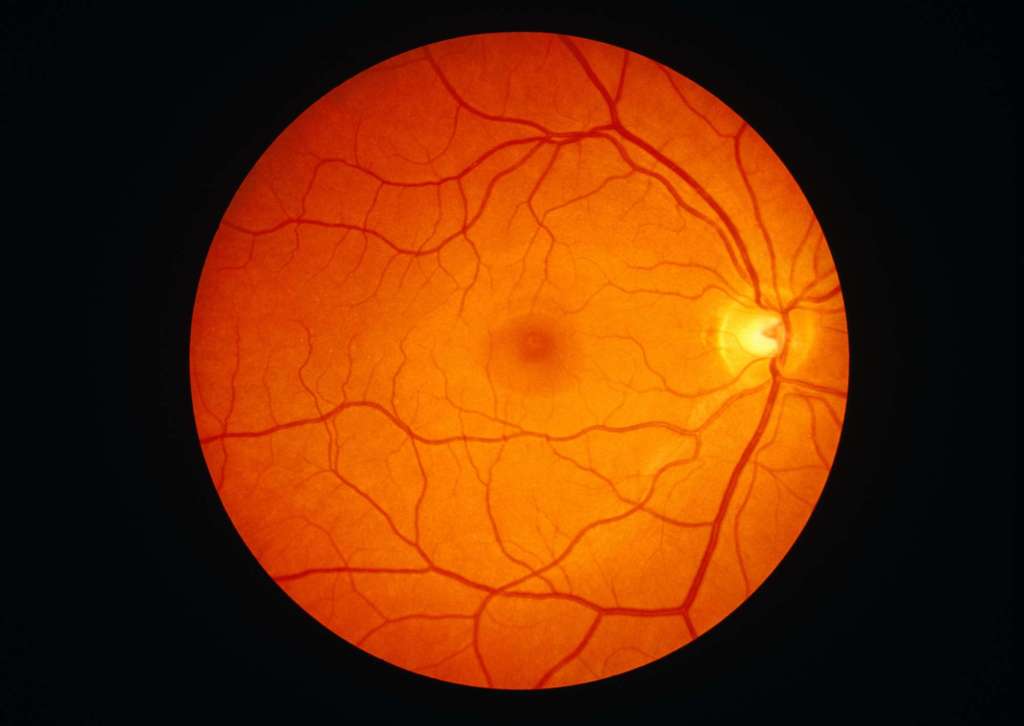 
The image is a detailed photograph of the retina, showing the interior surface of the eye. It is brightly illuminated in orange tones, highlighting the intricate network of blood vessels that spread out from the optic disc, which appears as a bright, slightly raised area on the right side of the image. The macula, a small, darker spot located towards the center-left, is also visible. The overall appearance is that of a circular view inside the eye, showcasing the vascular structure against the vibrant background of the retinal tissue.